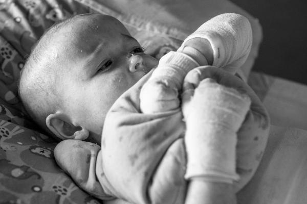 This photo is of an infant Epidermolysis Bullosa in pain.