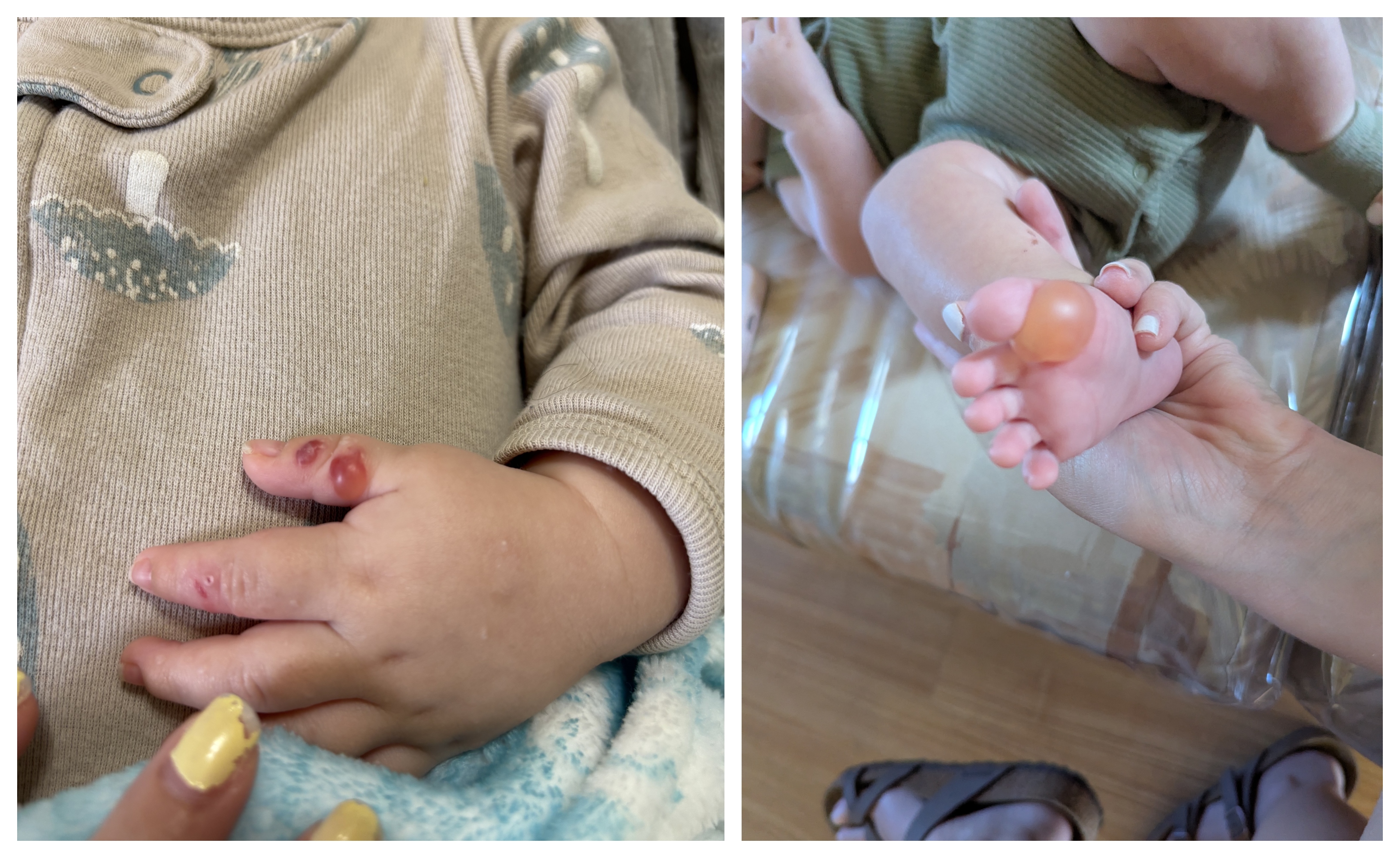 Epidermolysis Bullosa Personal Story