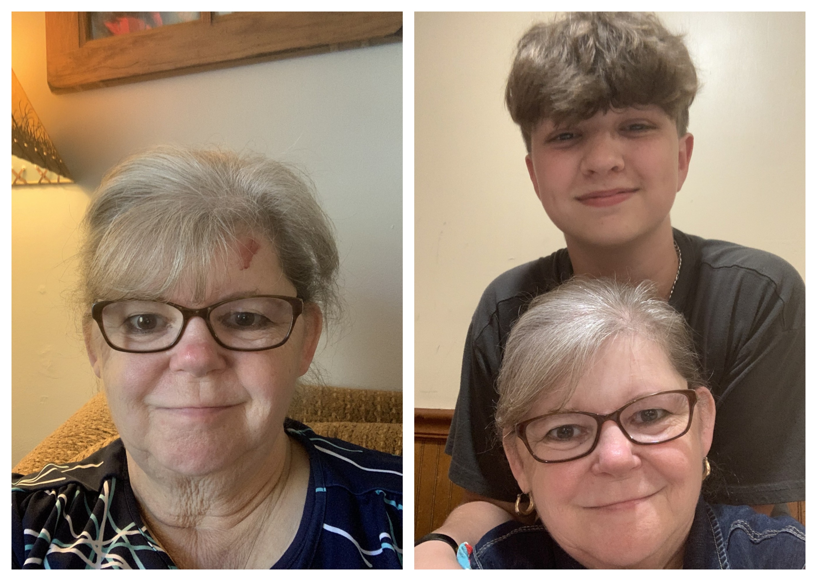 Epidermolysis Bullosa Personal Story