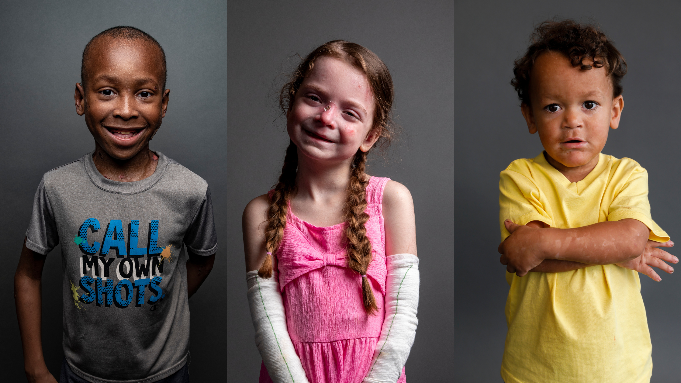 Students with Epidermolysis Bullosa (EB)