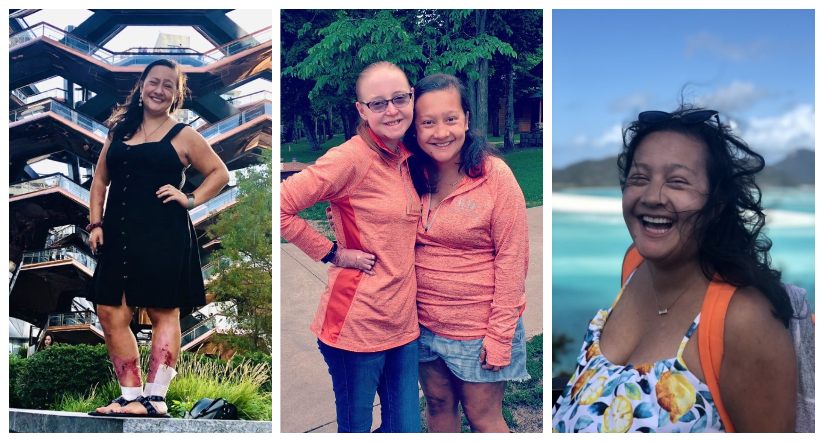 Epidermolysis Bullosa Personal Story