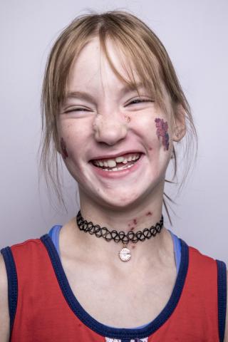 Child with Epidermolysis Bullosa