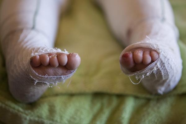 This photo is of the bandaged feet of a young boy with Epidermolysis Bullosa (EB).