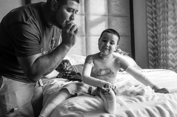 This photo is of father blowing bubbles with a young boy with Epidermolysis Bullosa (EB).