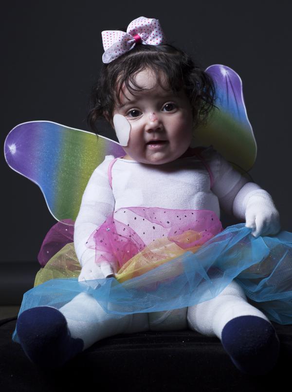 This photo is of Catt, a baby with Epidermolysis Bullosa (EB).