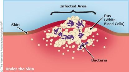 wound infection diagram